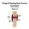 2 Stage Of Healing Bone Fracture. Formation of callus. The bone fracture. Infographics. Vector illustration on isolated