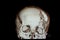 3-D redering film of a patient skull with traumatic brain injury