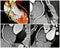 3D angio tomography rca collage
