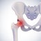 3D illustration of anterior view of hip bone showing painful position on white