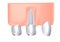 3d illustration of a dental implant in a gum.