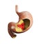 3d illustration of Stomach ulcer, human stomach anatomy