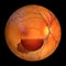 A 3D illustration of Terson syndrome, revealing intraocular hemorrhage observed during ophthalmoscopy