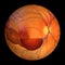 A 3D illustration of Terson syndrome, revealing intraocular hemorrhage observed during ophthalmoscopy
