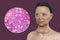 A 3D illustration of a woman with Graves' disease alongside a micrograph image of thyroid tissue affected by