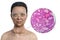 A 3D illustration of a woman with Graves' disease alongside a micrograph image of thyroid tissue affected by