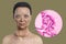 A 3D illustration of a woman with Graves' disease alongside a micrograph image of thyroid tissue affected by