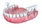 3d lower teeth and dental implant transparent render