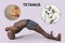 A 3D medical illustration of a black-skinned man suffering from tetanus, shown in the opisthotonus position, with a