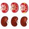 3D Realistic anatomy vector set kidney, normal kidney, kidney infection, sick kidney. Anatomy human. Medicine concept