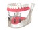 3d render of bar retained removable overdenture installation supported by four implants
