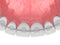 3d render of dental bonded retainer on upper jaw