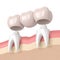 3d render of dental bridge with dental crowns