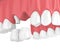 3d render of dental cantilever bridge with crowns in upper jaw