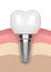 3d render of dental implant in gums