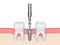 3d render of dental implant with multipeg to check implant stability