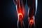 3D render of a female knee with highlighted knee joint on dark background, Diseases of the knee joint, bone fracture and