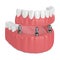 3d render of implant partial denture