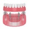 3d render of implant partial denture