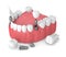 3d render of jaw with dental implants and bridges