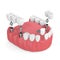 3d render of jaw with dental implants and bridges