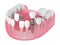 3d render of jaw with dental implants and bridges over white