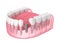3d render of jaw with implant screw and buried healing cap under gums
