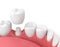 3d render of jaw with teeth and dental crown restoration