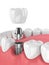 3d render of jaw with teeth and dental molar implant