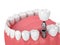 3d render of jaw with teeth and dental molar implant