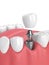 3d render of jaw with teeth and dental premolar implant