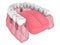 3d render of mandibular prosthesis all-on-6 system supported by implants