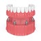 3d render of removable full implant denture