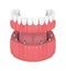 3d render of removable full implant denture