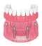 3d render of removable full implant denture