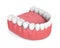 3d render of removable partial denture