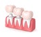 3d render of replacement crowns cemented onto reshaped teeth