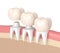 3d render of replacement crowns cemented onto reshaped teeth