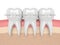 3d render of teeth with ceramic clear braces