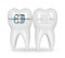 3d render of teeth with ceramic and metal braces