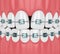 3d render of teeth with convergent diastema and braces