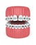 3d render of teeth with convergent diastema and braces