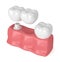 3d render of teeth with dental cantilever bridge