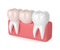 3d render of teeth with dental cantilever bridge