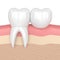 3d render of teeth with dental cantilever bridge