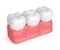 3d render of teeth with dental composite filling