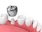 3d render of teeth with dental crown amalgam filling