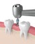 3d render of teeth with dental drill