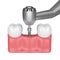 3d render of teeth with dental drill