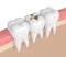 3d render of teeth with dental gold filling